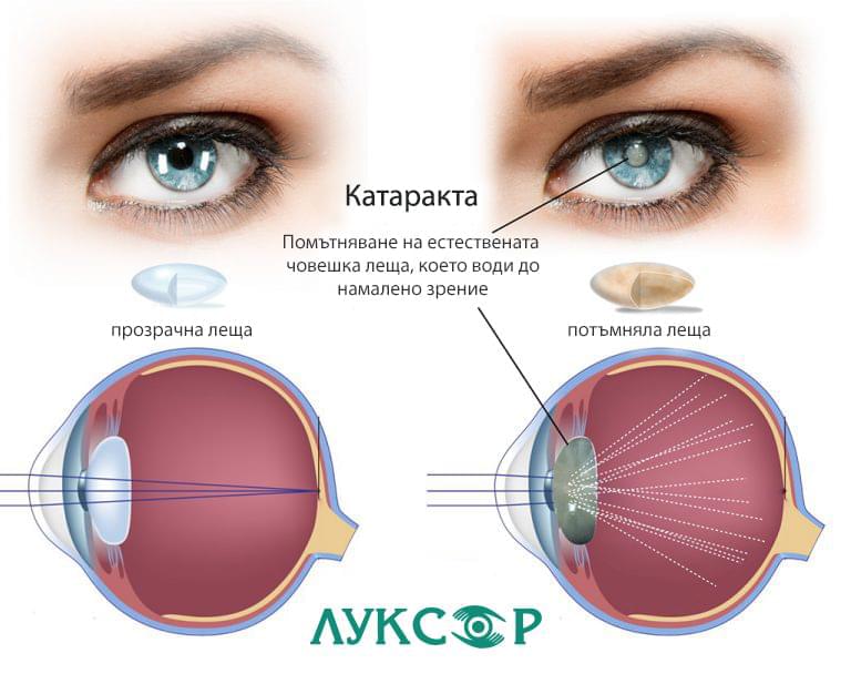 Катаракта (Старческо перде)
