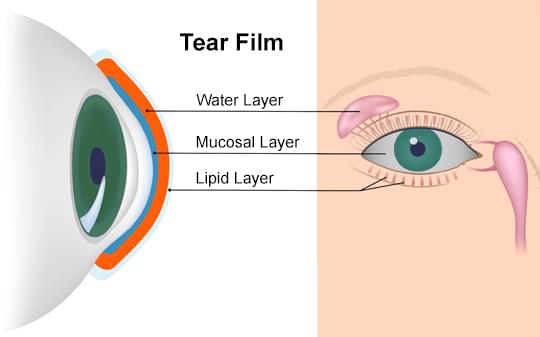 What is "Dry Eye" syndrome