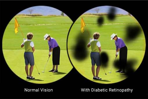 Eye disorders in diabetes