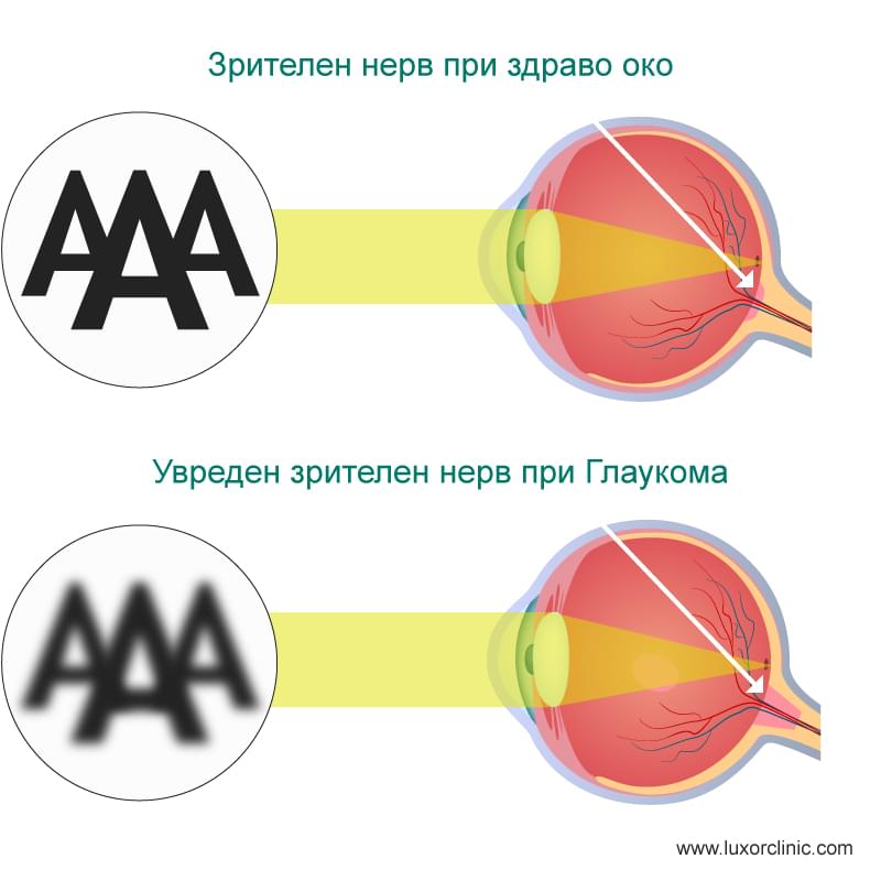 Глаукома
