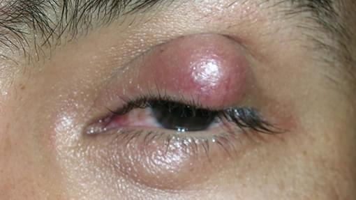 stye